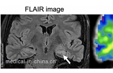 Detecting epilepsy with magnetic resonance elastography